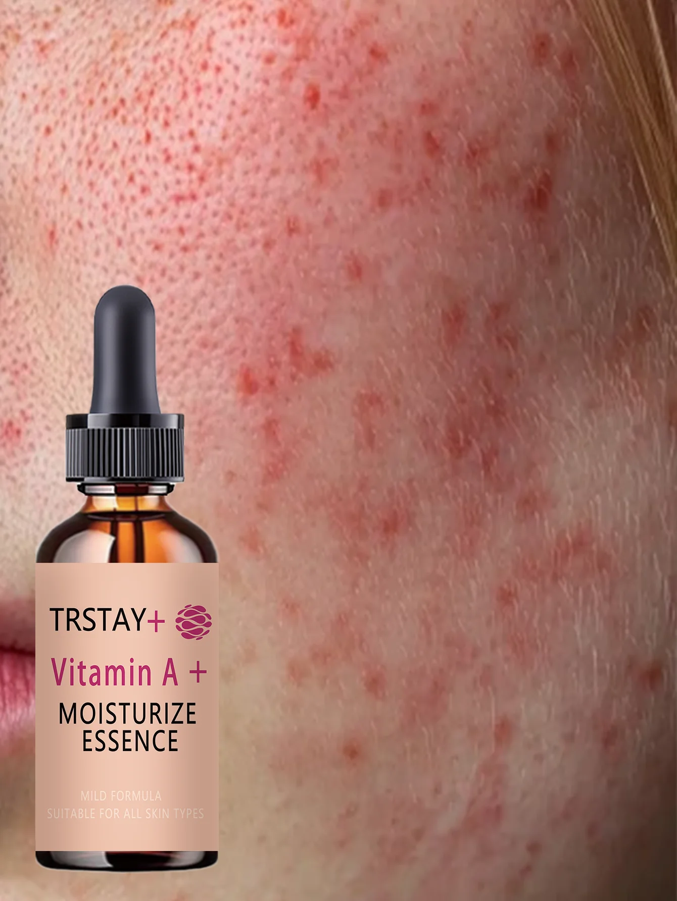 Acne-Fighting Essence, Fragrance-Free Skincare Product, With Plant Extracts, Gentle & Non-Irritating, Keeps Skin Hydrated, Light - Image 2