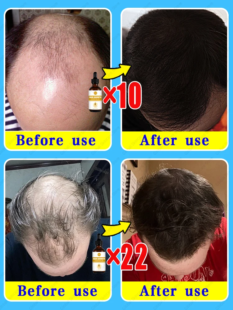 98% of customers repurchase, have more and more hair, say goodbye to baldness