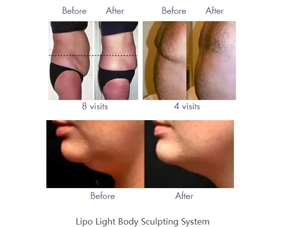 6D Lipolaser 기계, Lipo 레이저 바디 슬리밍, 셀룰라이트 제거, 무게추 감소, 지방 연소 장비