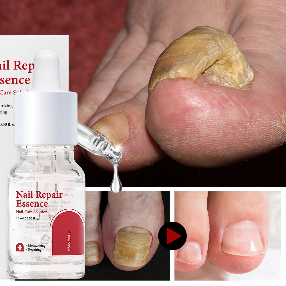 [Venta limitada especial] Medior Nail Problem Nail Nail Atleta Hongo Cuidado concentrado Suero nutritivo Esencia reparadora