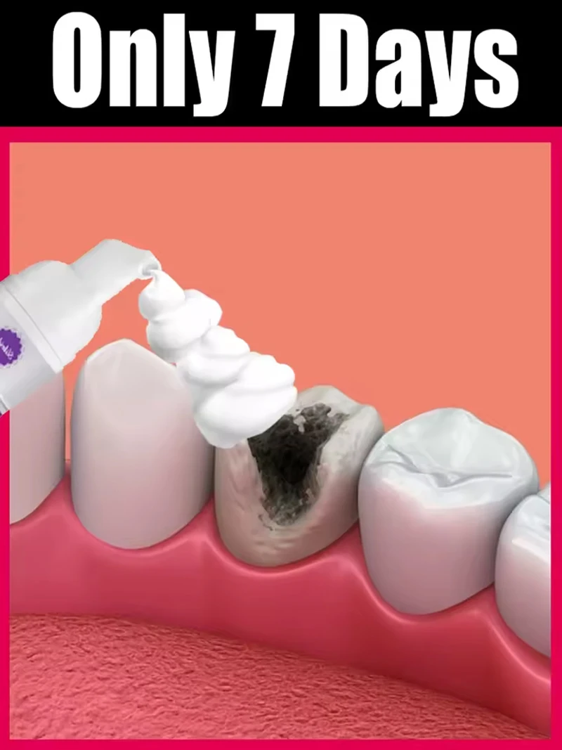 Dental Bacterial Plaque, Tartar Removers Dissolve Tartar And Remove Stains