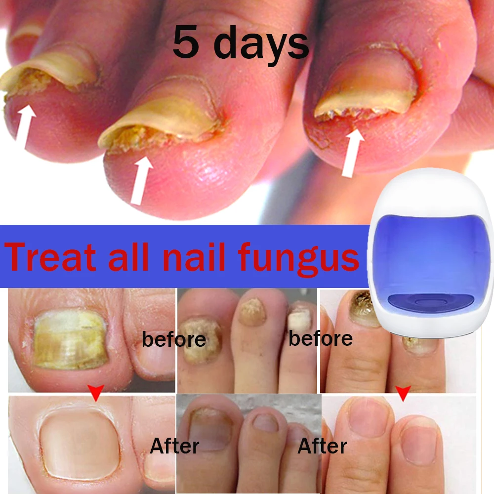 Nail Fungus Cleaning Laser Device Treatment Anti-Infective Paronychia Onychomycosis Care light-activated therapy