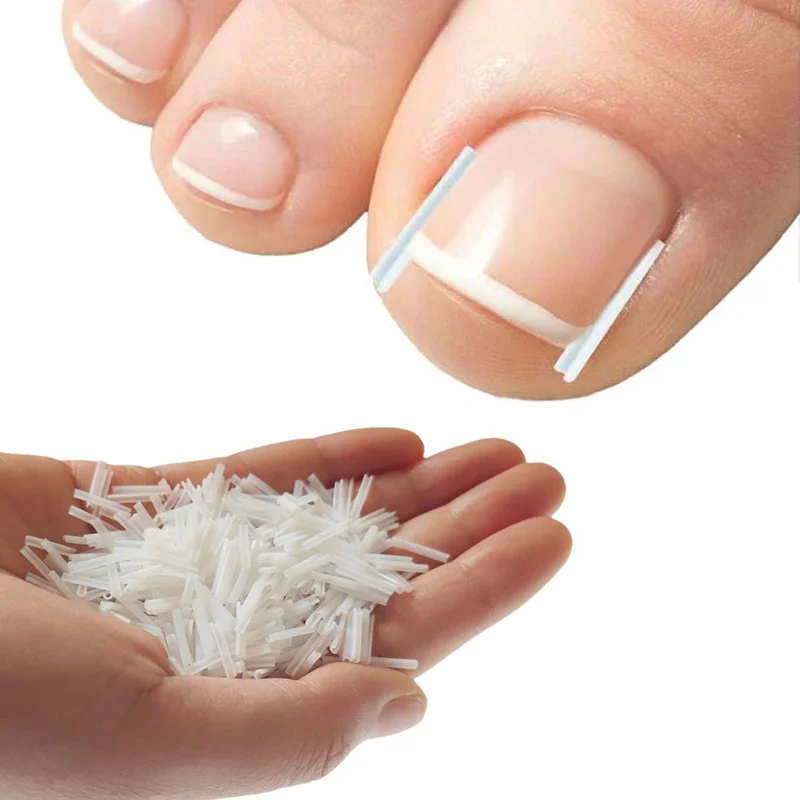 Outil de Correction des ongles incarnés, tampon de remplissage des ongles, traitement des ongles incarnés, Patch élastique, Clip de redressage, outil de pédicure