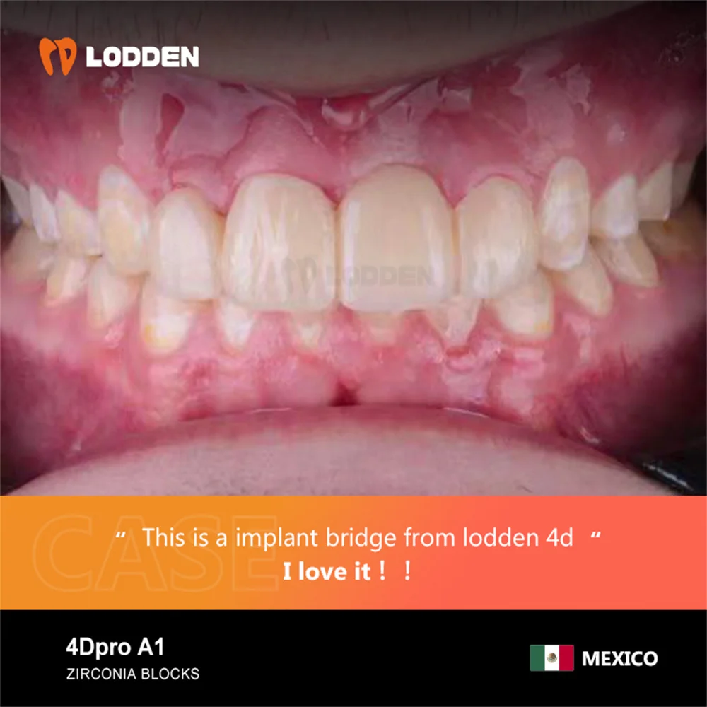 LODDEN 1300 MPa 98 x 16 mm Zirkonoxidblöcke Dentallabor Mehrschichtige 4D Pro Max Ästhetik 8 Schichten Scheiben für CAM CAD Prothesenmaterialien – Detail 7