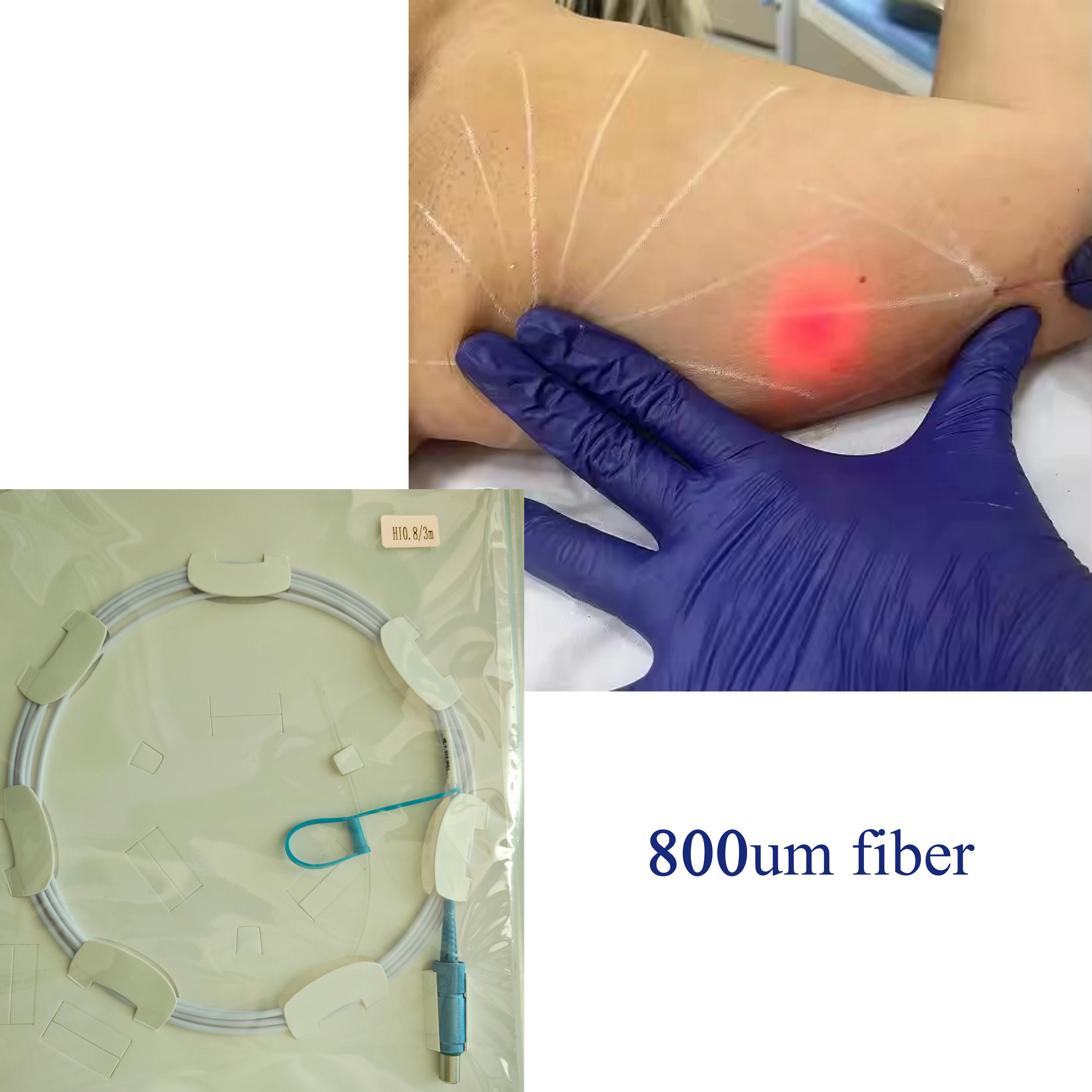 SMA905 800μm Blankes Optisches Faserkabel – Spezielles Zubehör für EVLT, Lipolyse, PLDD, Hämorrhoidenbehandlungen & Endo-Facelifting