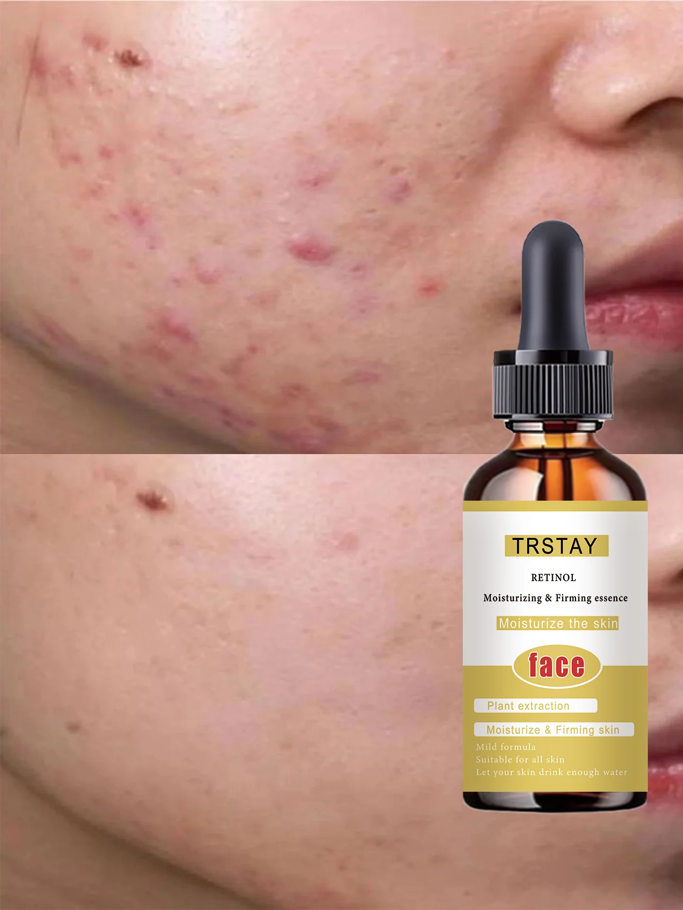 Acne-Fighting Essence, With Plant Extracts, Gentle & Non-Irritating, Fragrance-Free Skincare Product, Lightweight & Non-Greasy, - Image 4
