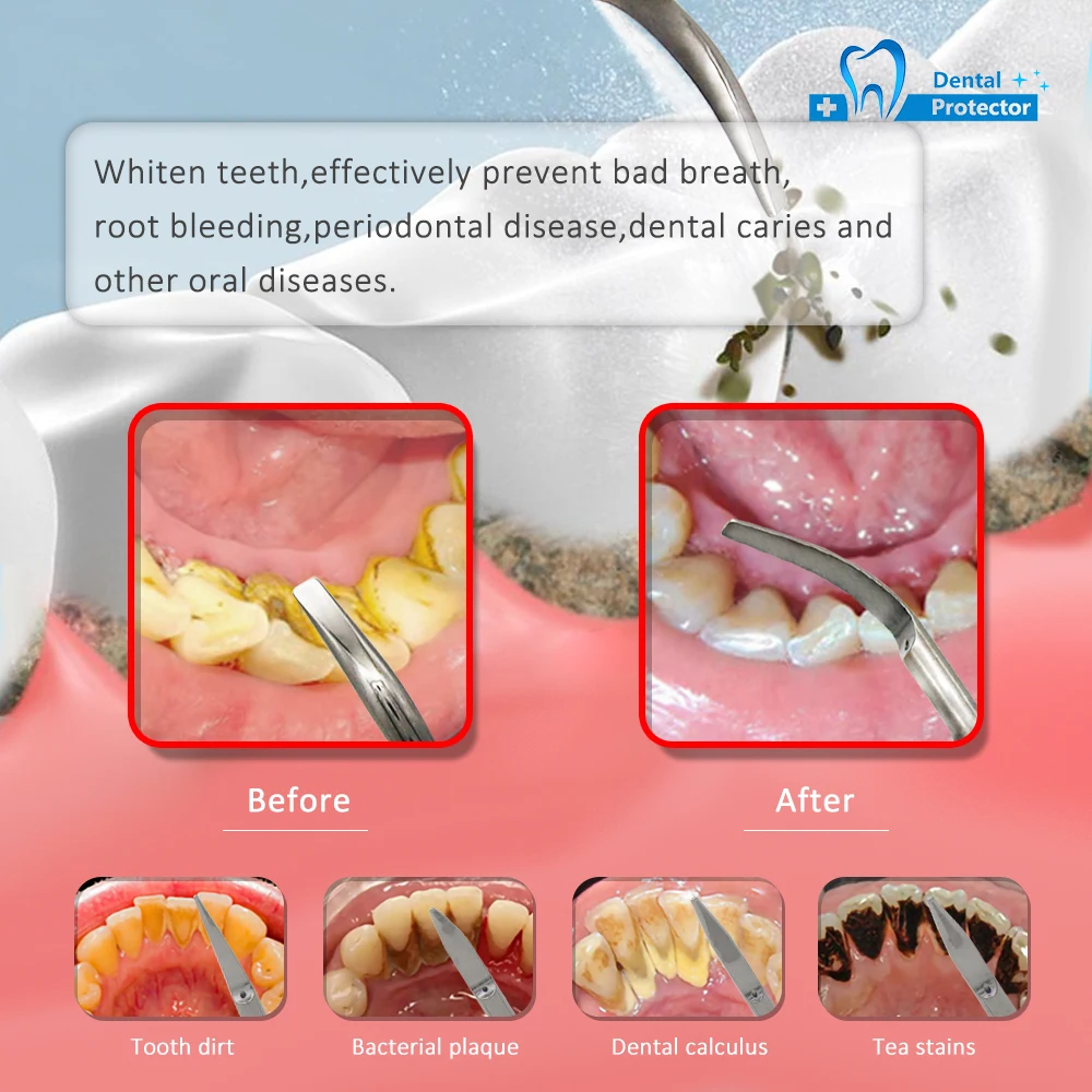 طرف مختلط للأسنان (P1 G1 G2 G3 G4) تناسب التحجيم EMS ، نقار الخشب