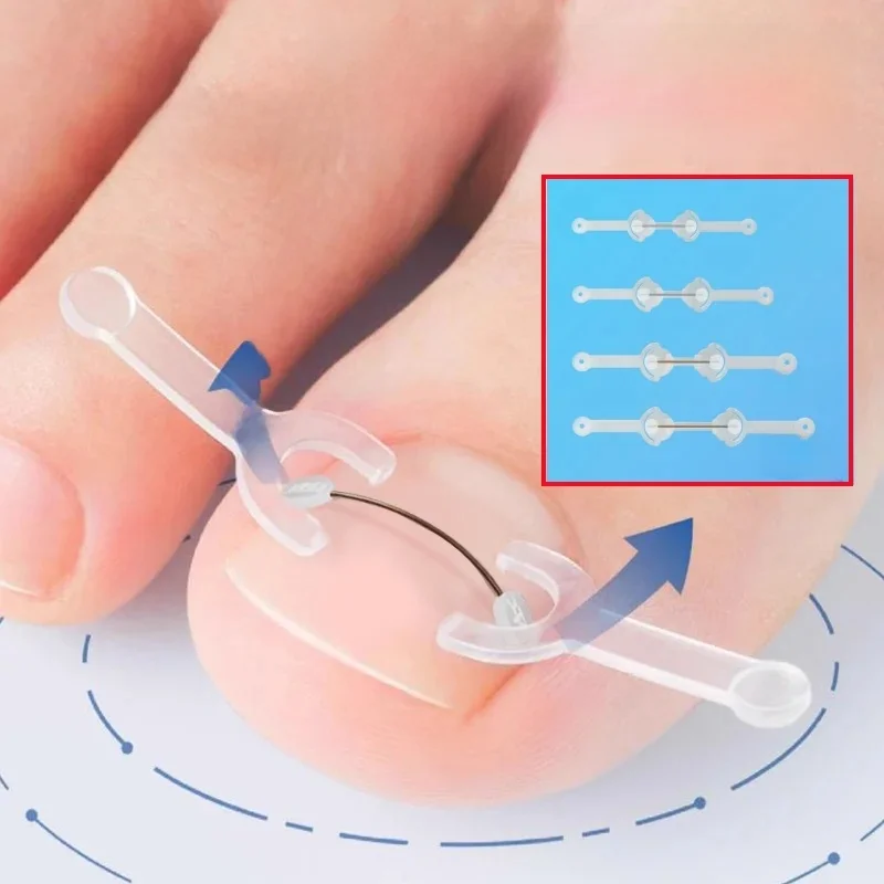 Narzędzie do korekcji wrastających paznokci Leczenie wrastających paznokci u stóp Elastyczna naszywka Naklejka Klips do prostowania Brace Pedicure Tool — zdjęcie 2