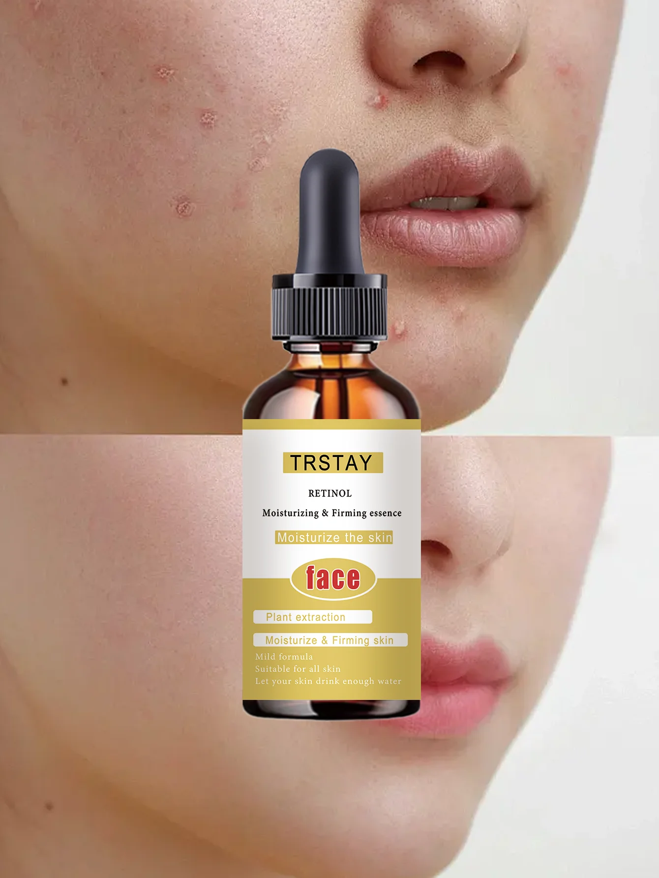Acne-Fighting Essence, With Plant Extracts, Gentle & Non-Irritating, Fragrance-Free Skincare Product, Lightweight & Non-Greasy, - Image 6