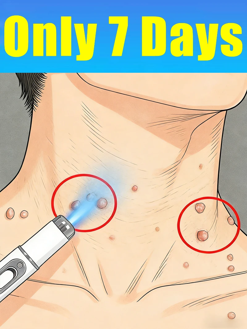 

Ручка с синим светом для удаления всех типов бородавок на шее, лазерные инструменты для удаления бородавок