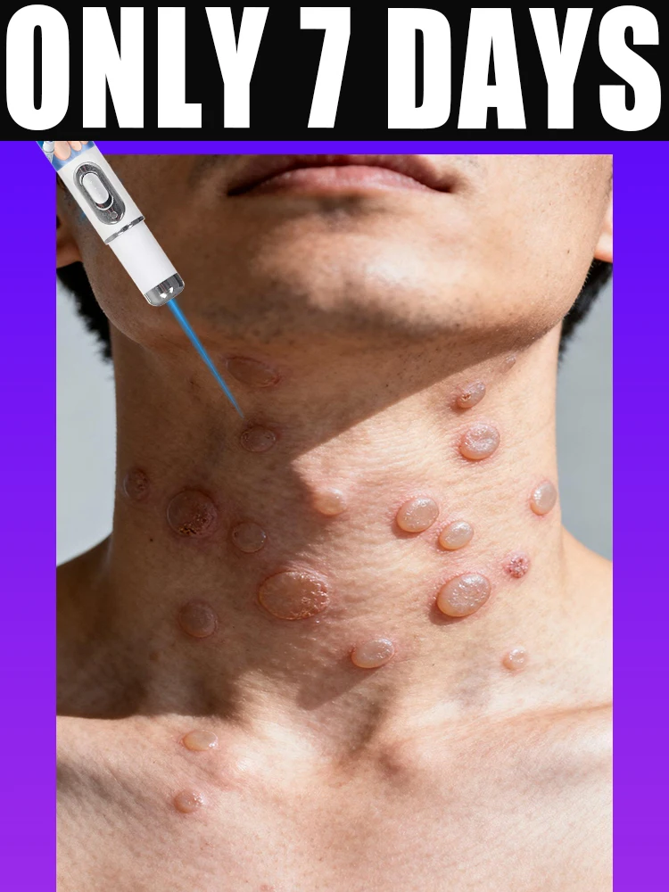 

blue light laser pen get rid of filiform wart flat warts plantar wart