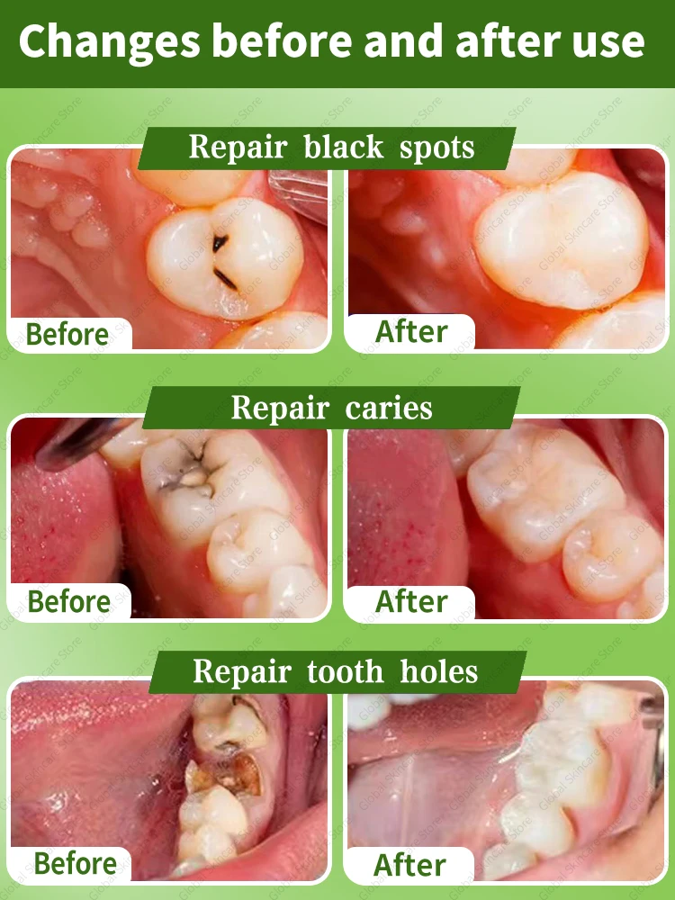 Karies reparatur Reparatur von Hohlräumen zum Schutz von Karies