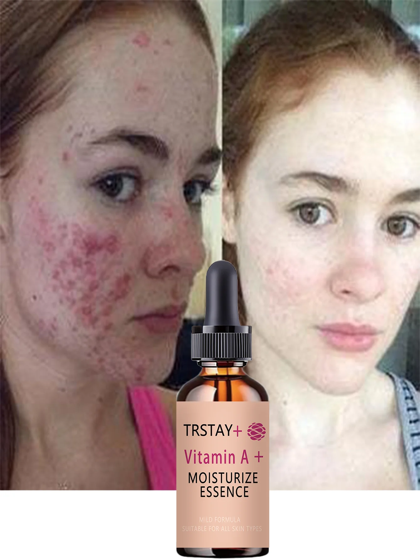 Acne-Fighting Essence, Fragrance-Free Skincare Product, With Plant Extracts, Gentle & Non-Irritating, Keeps Skin Hydrated, Light - Image 4