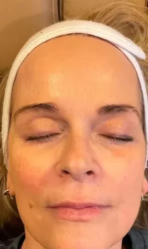 Anti‑Wrinkle Micro‑Needle Infusion Essence | Deep Penetration Facial Serum
