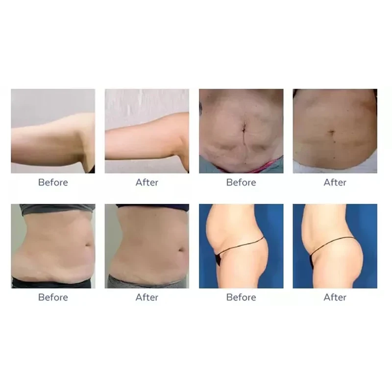 Velashape Vacuum RF Roller Slimming Body Lifting Massage Physiotherapy Weight Loss ABS Desktop Machine view 4