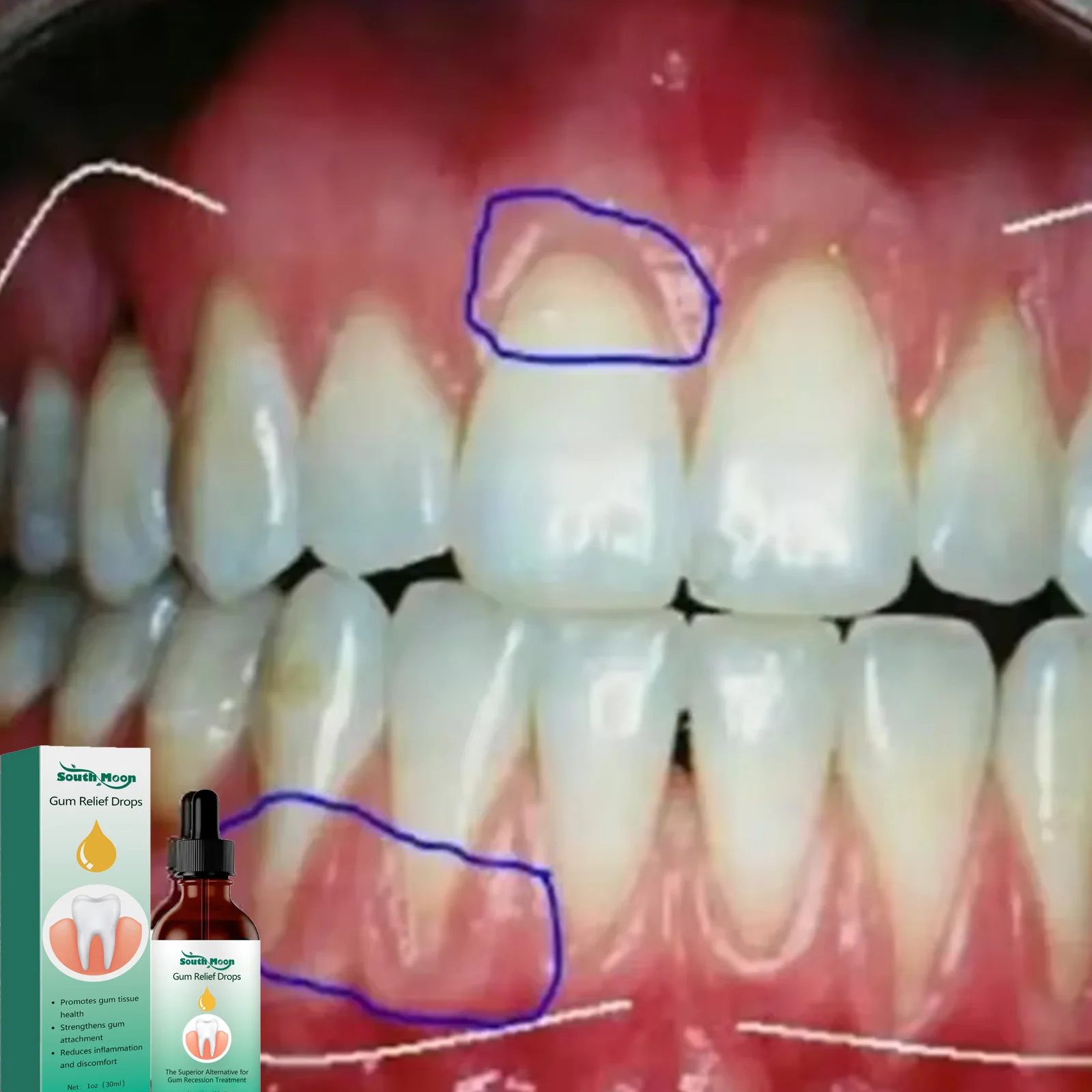 잇몸 세럼 케어 치아 미백 제거, 노란색 잇몸 재생 플라크 얼룩 제거, 잇몸 부식 치통 완화