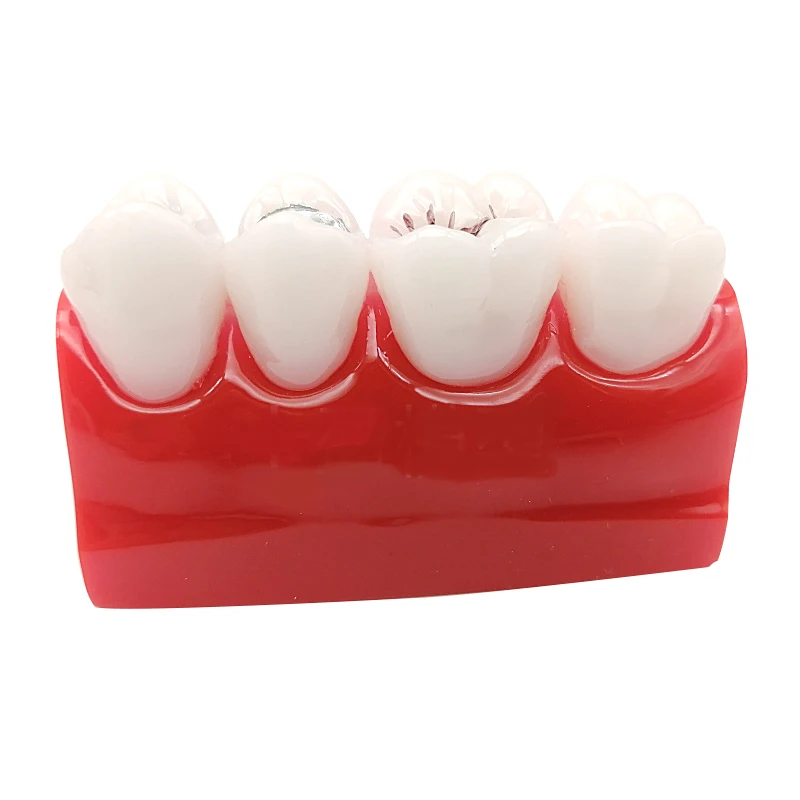 Dental Caries Model Treatment for Sealant and lnlay Demonstration Mode 1pc