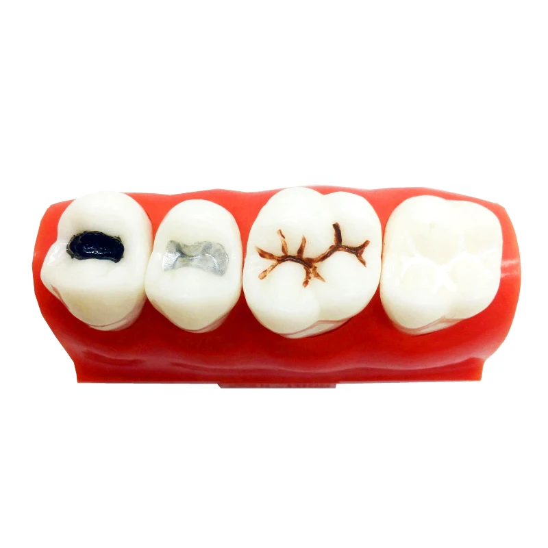 Dental Caries Model Treatment for Sealant and lnlay Demonstration Mode 1pc