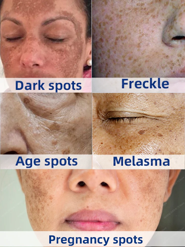 Dunkle Flecken entfernen Creme Sommersprossen Melasma Sun Age Spot