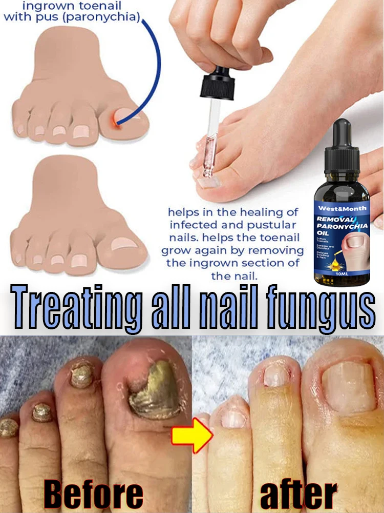 

Comes with nail fungus treatment tools, paronychia is simple and quick to treat, say goodbye to onychomycosis in 5 days.