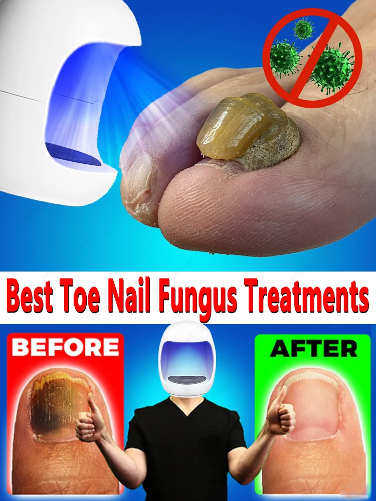 

Laser solves all nail problems