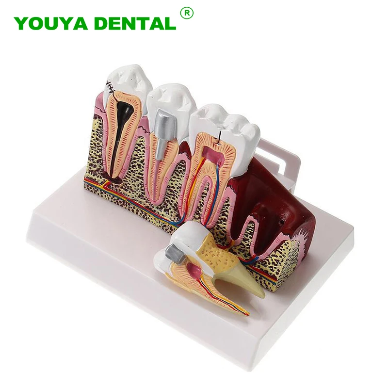 

Dental Anatomy Model Teeth Pathologies Anatomical Teaching Model Daries Root Canal Treatment Demonstration Communication Model