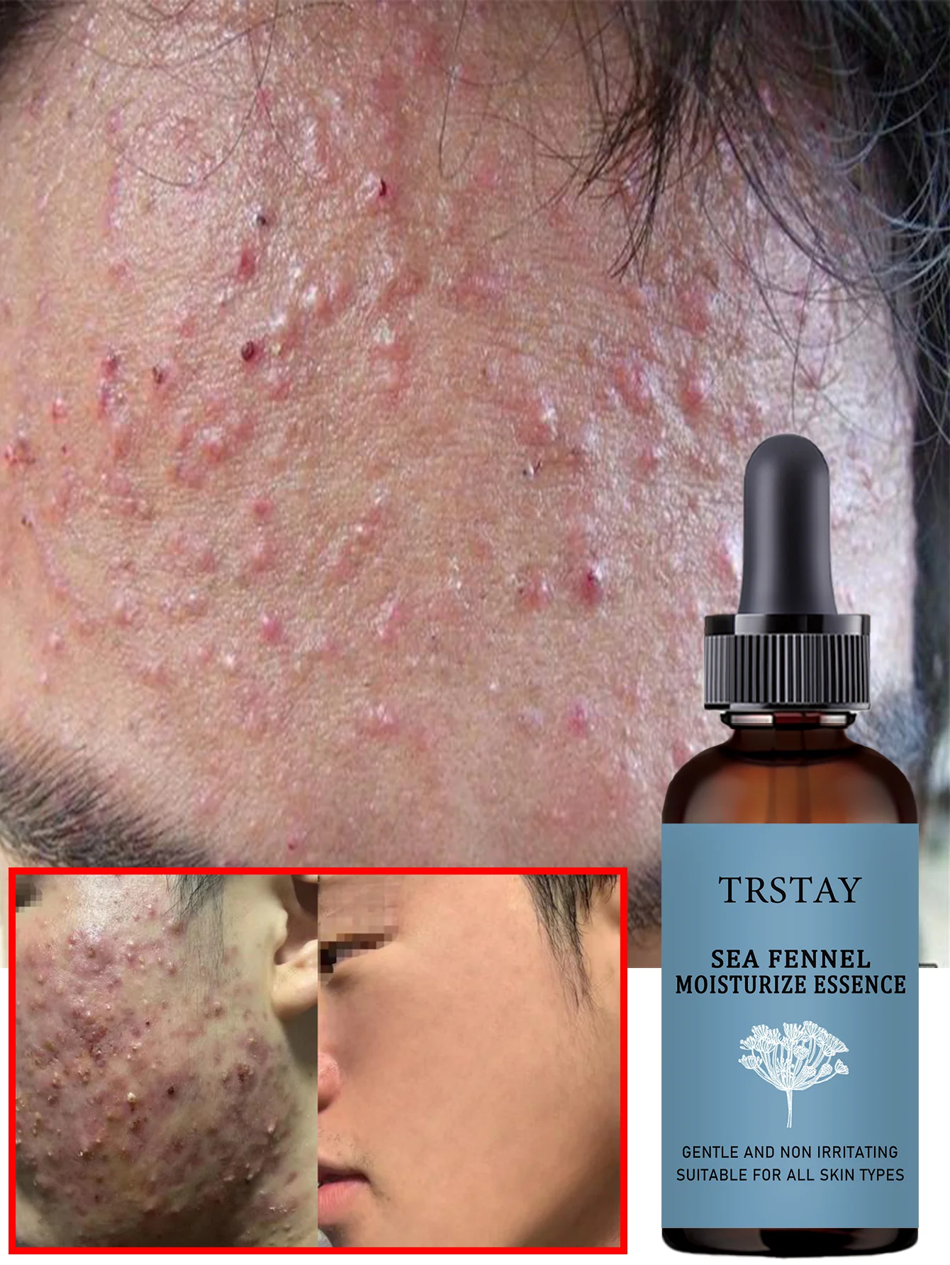 Acne-Fighting Essence, Unscented Formula, With Plant Extracts, Lightweight & Non-Greasy, Gentle & Non-Irritating, Suitable for A