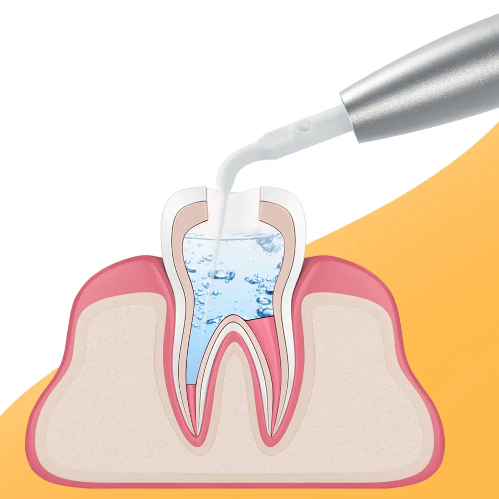 Exp Dental Air Scaler, Perio Scaling com 5 Dicas, Irrigação Ativação, Tooth Cleaner, 2, 4 Buracos