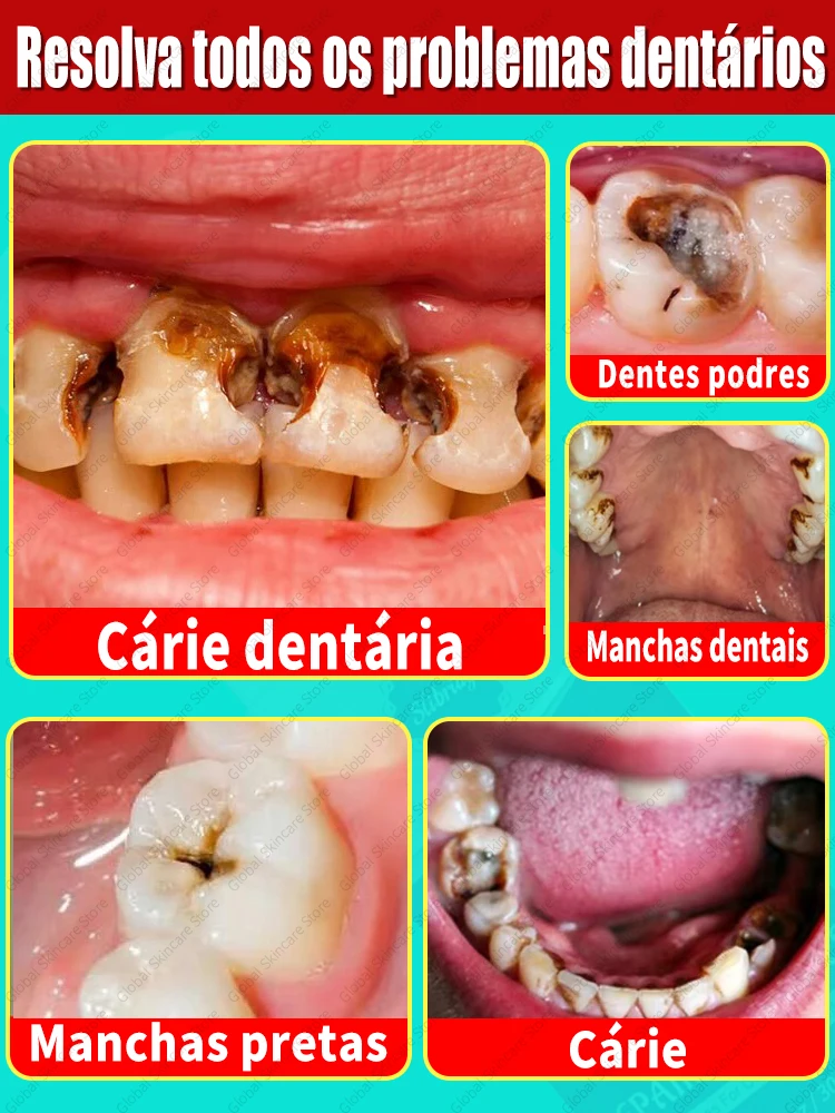 Tooth decay Repair Repairing Cavities Protecting Anti Caries