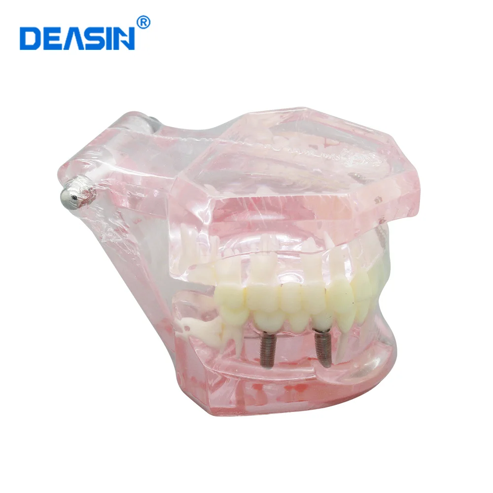 

Teeth Model Dental Implant Disease Restoration Medical Science Disease Teaching Study school quality Tooth model Dentist Use