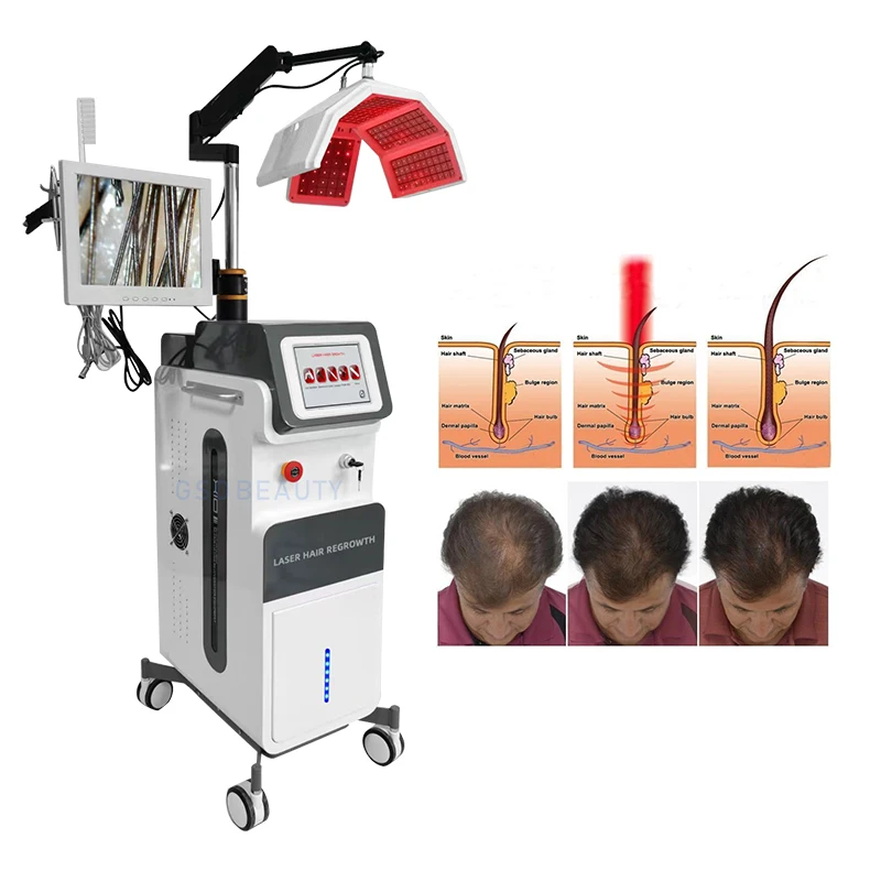 Diode Laser Hair Regrowth With Diodes 650nm PDT red light therapy machine for hair loss treatment  regrowth scalp care