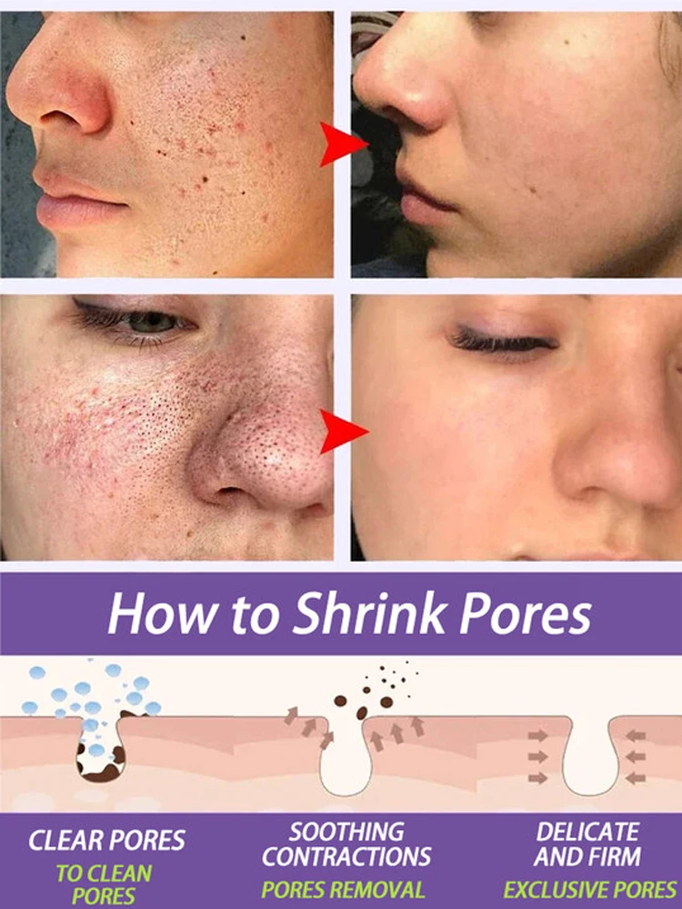 Soro De Encolhimento De Poros, Remoção Facial, Poros Grandes, Reparar De Apertar, Creme Minimizador De Poros Faciais