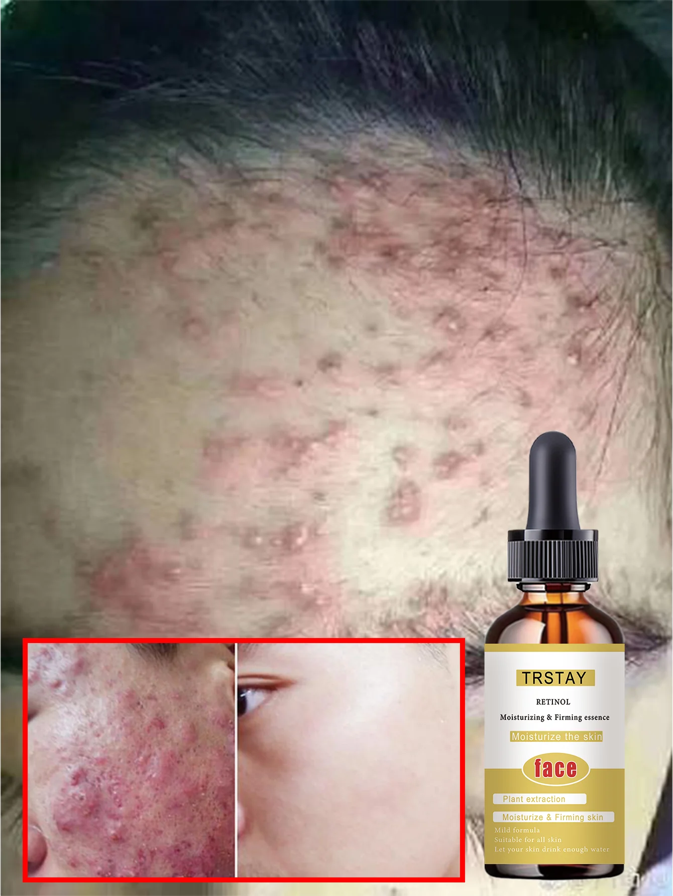 Acne-Fighting Essence, With Plant Extracts, Gentle & Non-Irritating, Fragrance-Free Skincare Product, Lightweight & Non-Greasy, - Image 5