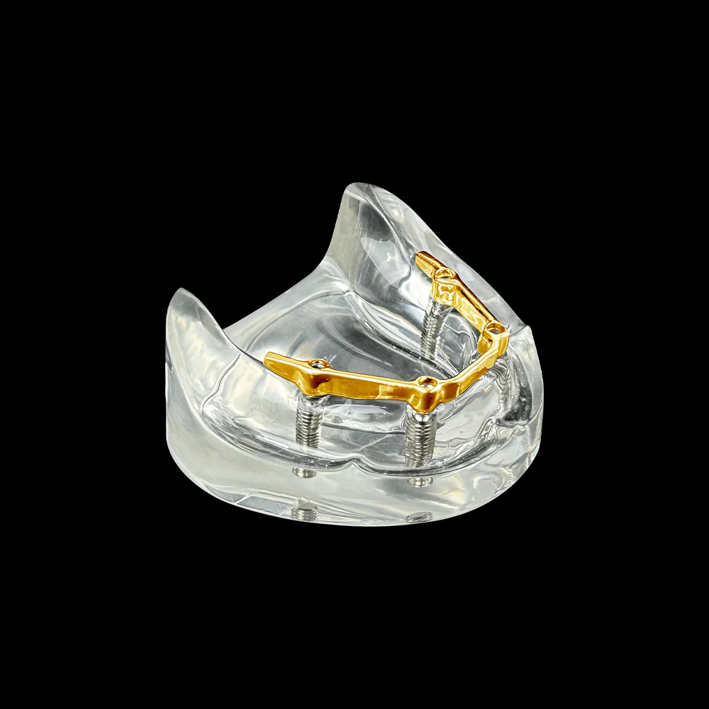 

1 Pcs Toothless Implant Model Detachable Dental Bridge With Gold/Silver Rods 4 Implants For Dentistry Students Practice Training