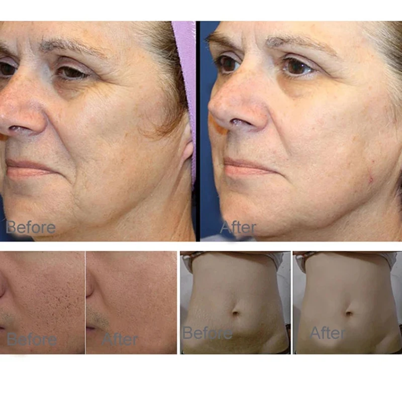 Plasma portátil 2 en 1 para uso profesional, máquina reafirmante de elevación de Plasma caliente y frío para el cuidado de la piel, eliminación de arrugas, antienvejecimiento