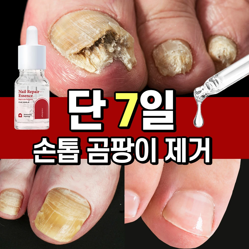[특가 한정판매] 메디올가 문제성 손발톱 집중 완벽케어 영양세럼 네일 리페어 에센스