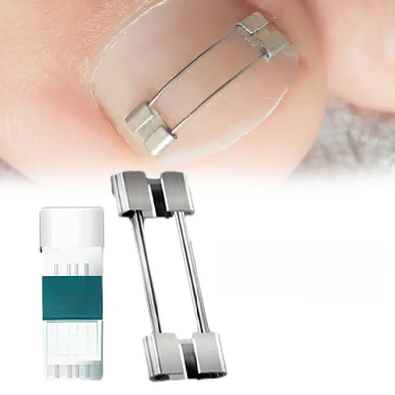 Correcteur d'ongles incarnés, outils de pédicure, récupération intégrée, traitement des ongles des orteils, professionnel, redressage des ongles incarnés, attelle à Clip