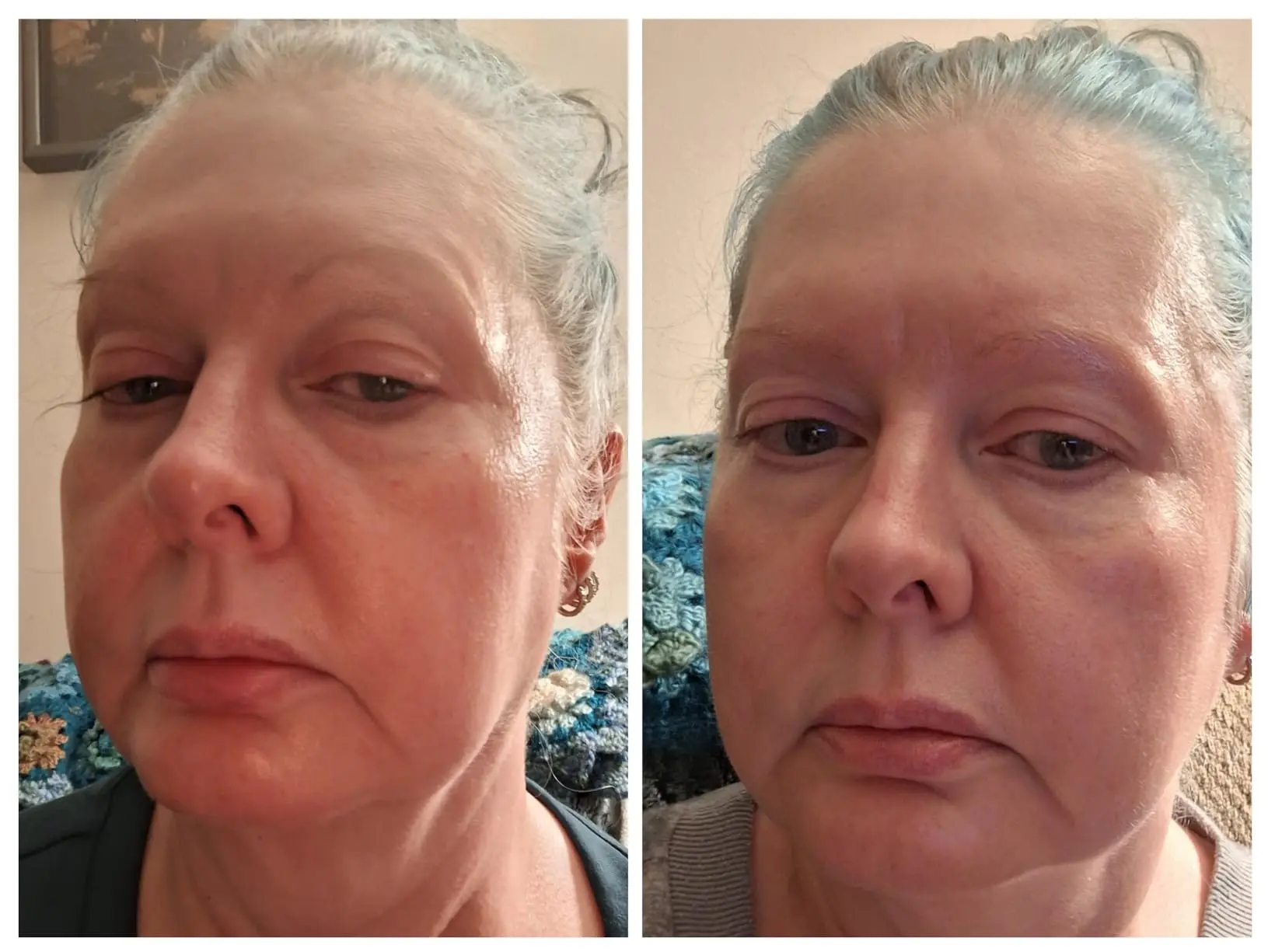 Anti‑Wrinkle Micro‑Needle Infusion Essence | Deep Penetration Facial Serum