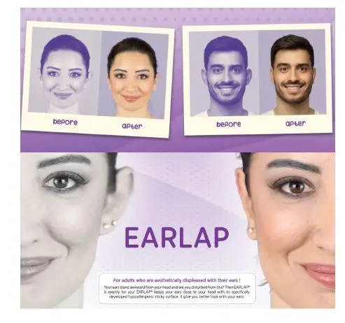 EARLAP MAXHOLD Economic 3 Packs Bulk Price Ear Correction System Cauliflower Protruding Corrector Flatter Arilis