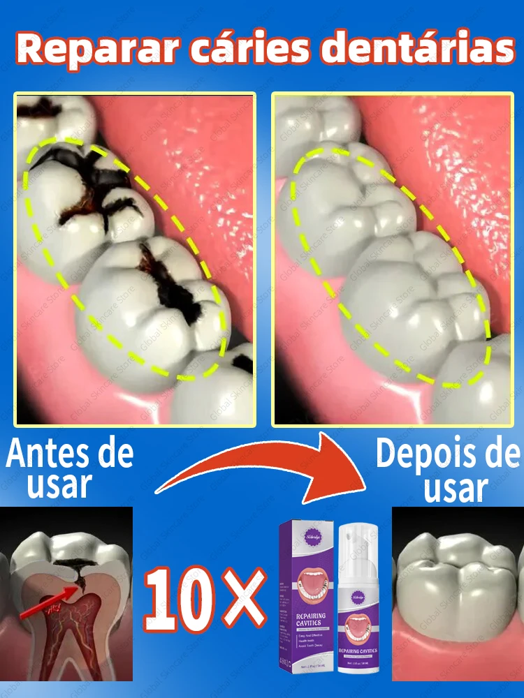 Tooth decay Repair Repairing Cavities Protecting Anti Caries