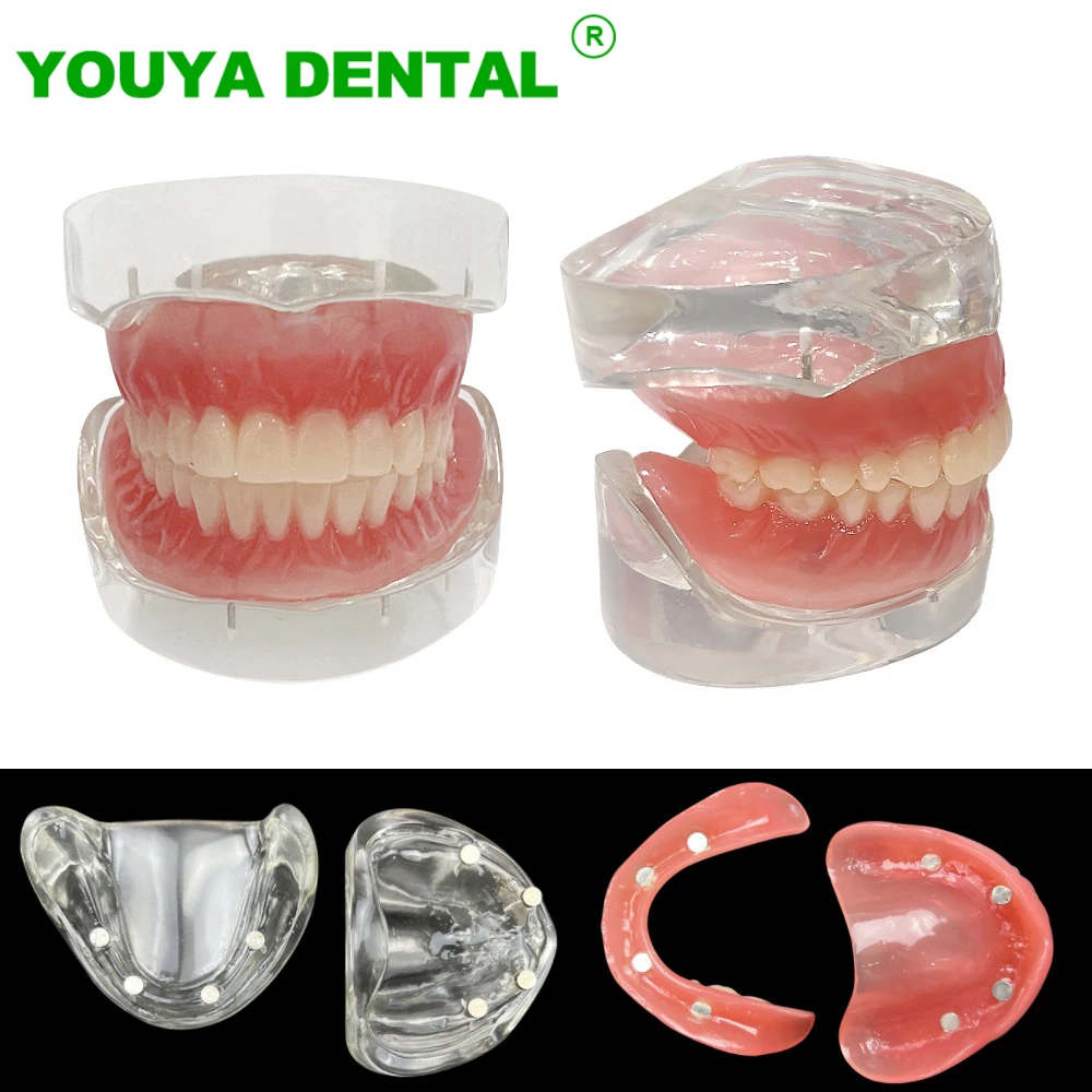 Dental Overdenture Teeth Model Superior Upper/Lower Jaw Demo Model With Removable Bridge 4 Implants Restoration Teaching Study