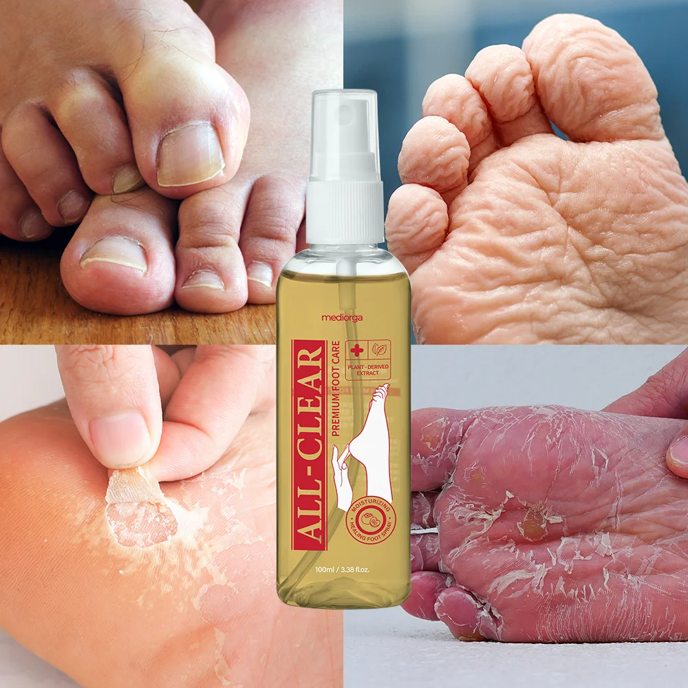 [Special Limited Sale Offer] Mediorga All Clear Foot Mist – Comprehensive Care for Foot Odor, Calluses, and Various Foot Concerns