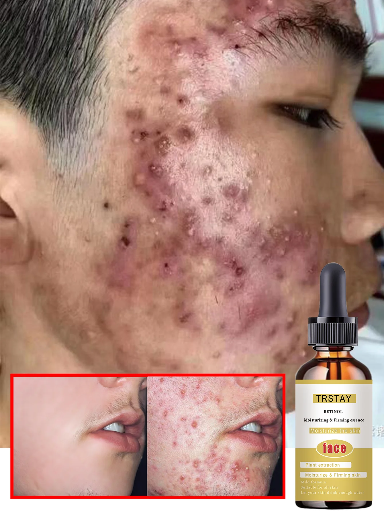 Acne-Fighting Essence, With Plant Extracts, Gentle & Non-Irritating, Fragrance-Free Skincare Product, Lightweight & Non-Greasy,