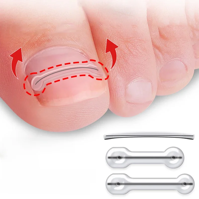 2 sztuk wrastający paznokieć narzędzie do korekcji wrastający palec u nogi leczenie elastyczna łatka naklejka klips do prostowania Brace Pedicure narzędzie — zdjęcie 2