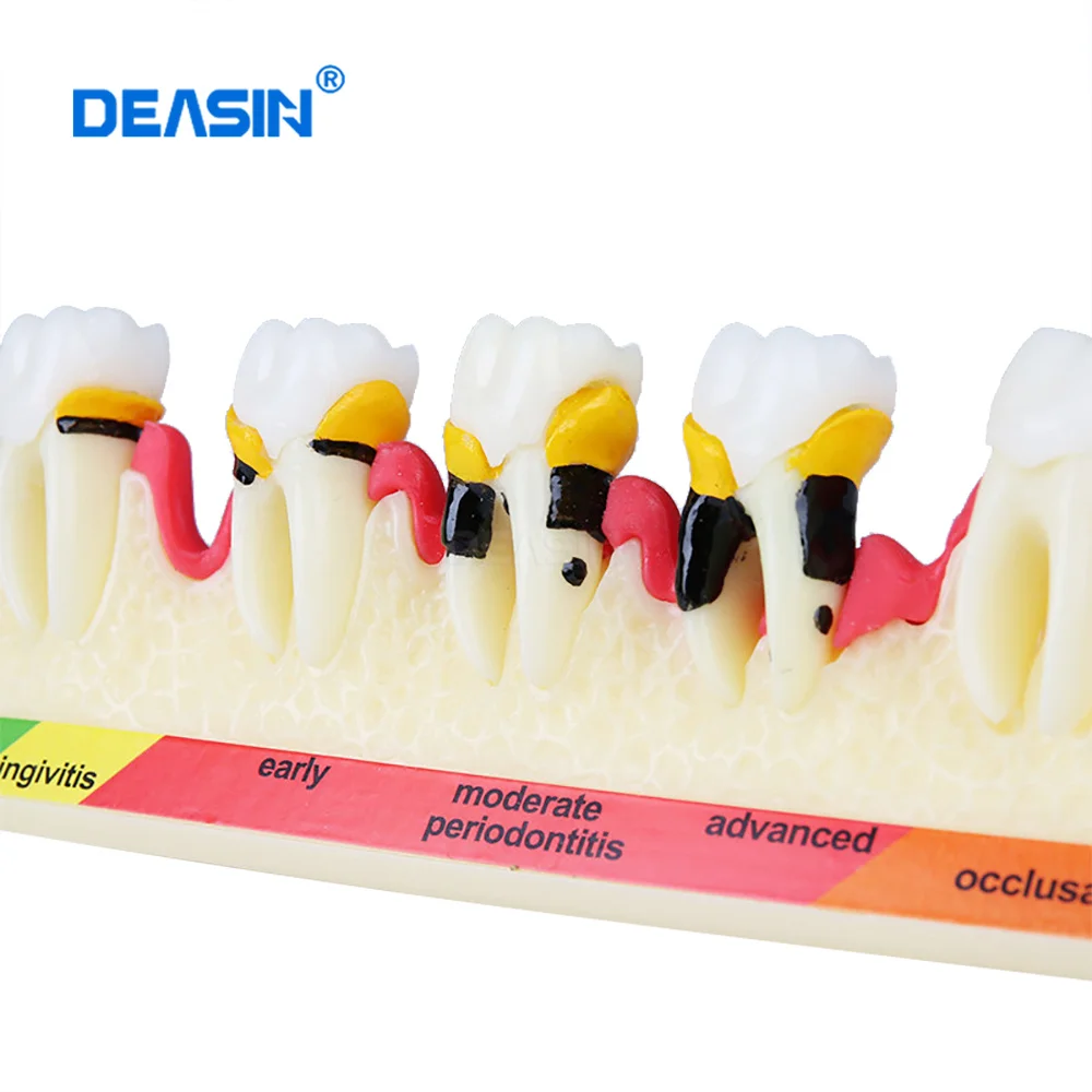 

Dental Periodontal disease model M4010 Demonstrates the progress of Periodontal disease/Dental caries Study teeth model