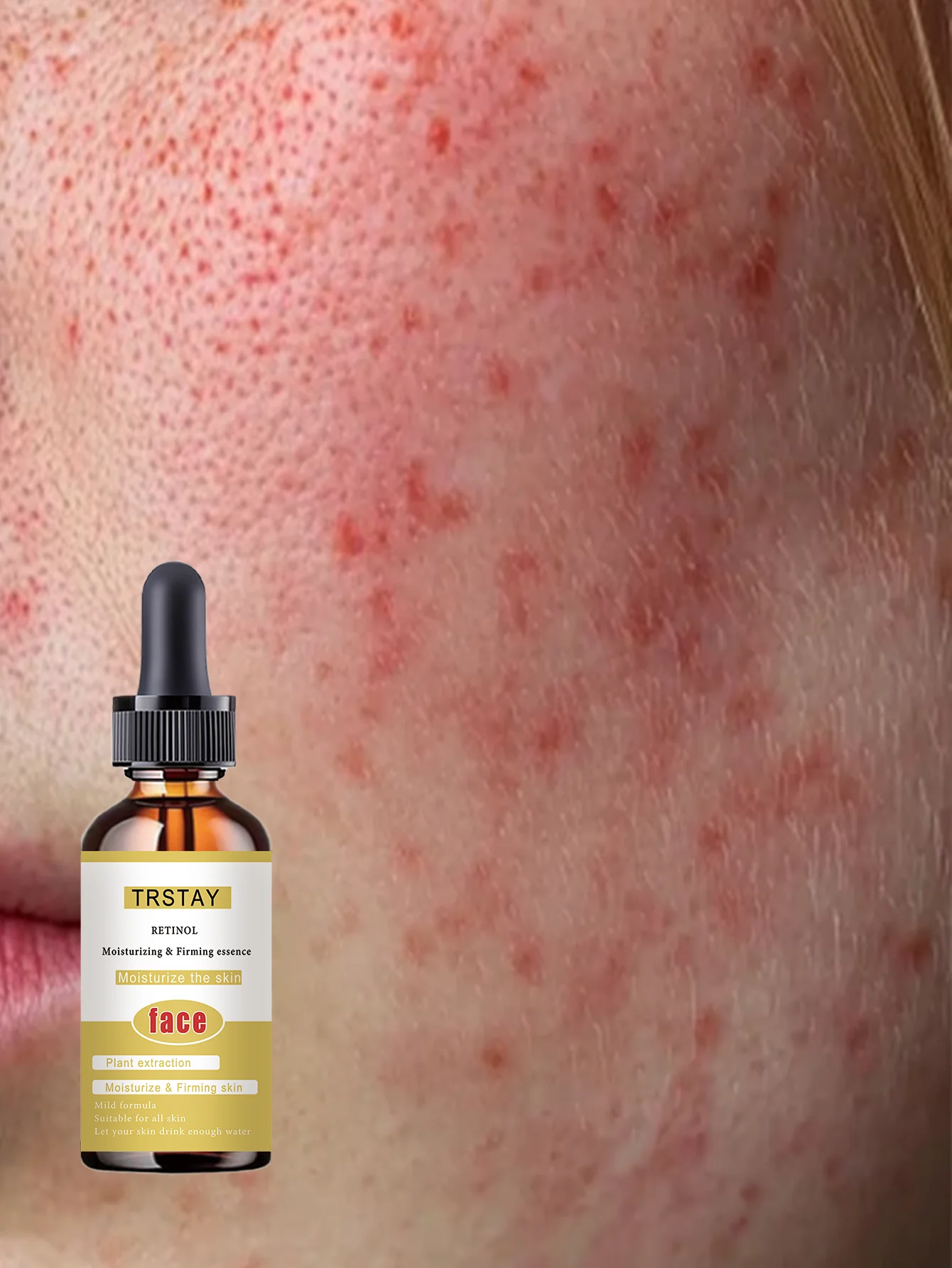 Acne-Fighting Essence, With Plant Extracts, Gentle & Non-Irritating, Fragrance-Free Skincare Product, Lightweight & Non-Greasy, - Image 3