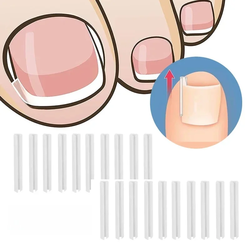 Patch autocollant élastique, outil de pédicure, outil de Correction des ongles incarnés, traitement des ongles incarnés, Clip de redressage, 50 pièces