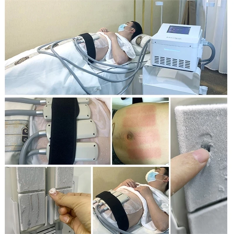 Niet-invasieve Cyro Emslim 4 Cooling Pads Cellulitis Verwijdering Vet Gewichtsverlies Vet Bevriezing Plaat Met Emslim Spa Home schoonheid Machine
