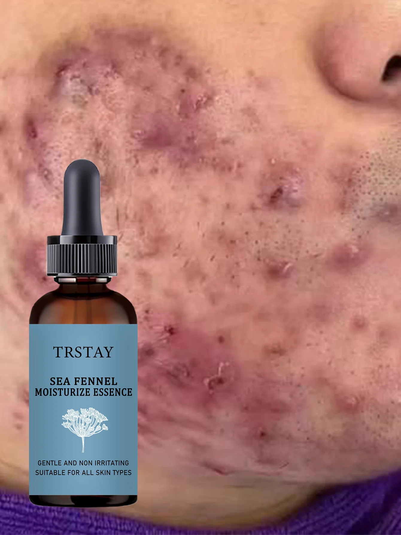 Acne-Fighting Essence, Unscented Formula, With Plant Extracts, Lightweight & Non-Greasy, Gentle & Non-Irritating, Suitable for A - Image 4