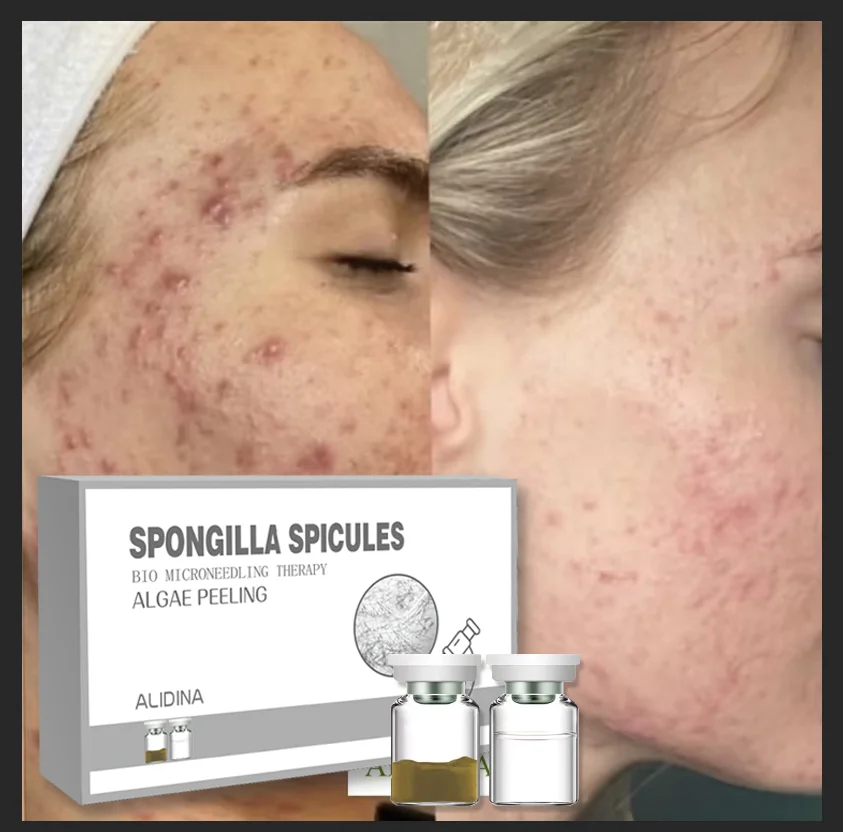 Kit de tratamiento de especias, exfoliación de algas, exfoliación de algas marinas, pigmentación del acné, tratamiento de esponja, especias de esponja